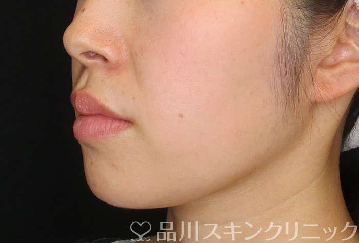 症例NO.74142のBEFORE写真
