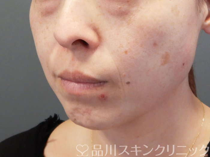 症例NO.72769のBEFORE写真