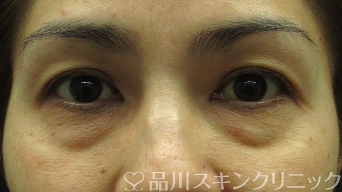 症例NO.70505のBEFORE写真