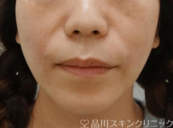 症例NO.31884のAFTER写真