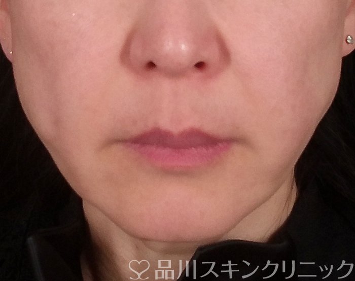 症例NO.69466のBEFORE写真