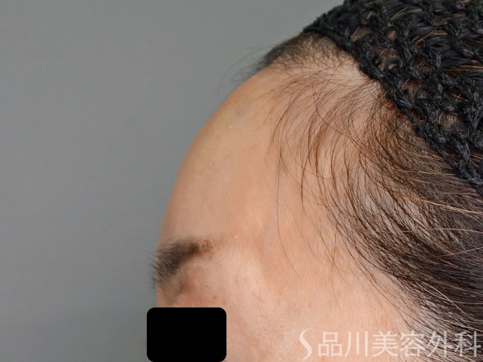 症例NO.70541のAFTER写真