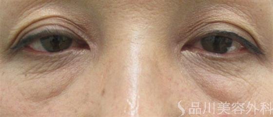 症例NO.15480のBEFORE写真