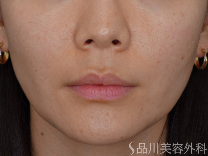 症例NO.73446のBEFORE写真