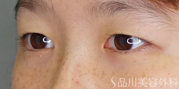 症例NO.70262のBEFORE写真