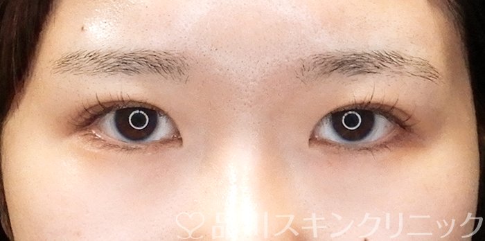 症例NO.63670のAFTER写真