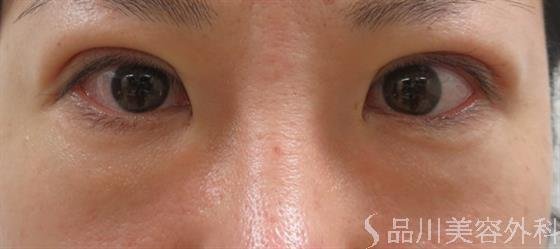 症例NO.35384のAFTER写真