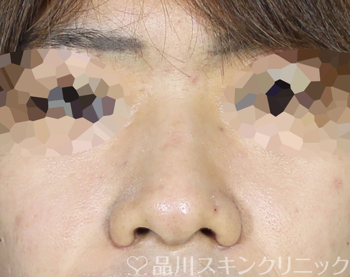 症例NO.62572のAFTER写真