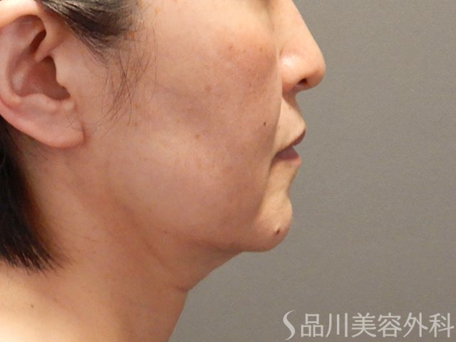 症例NO.74390のBEFORE写真