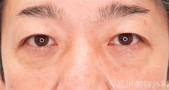 症例NO.60633のAFTER写真