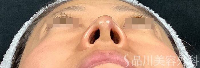 症例NO.67914のAFTER写真