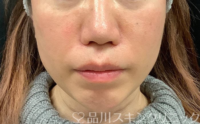 症例NO.69065のBEFORE写真