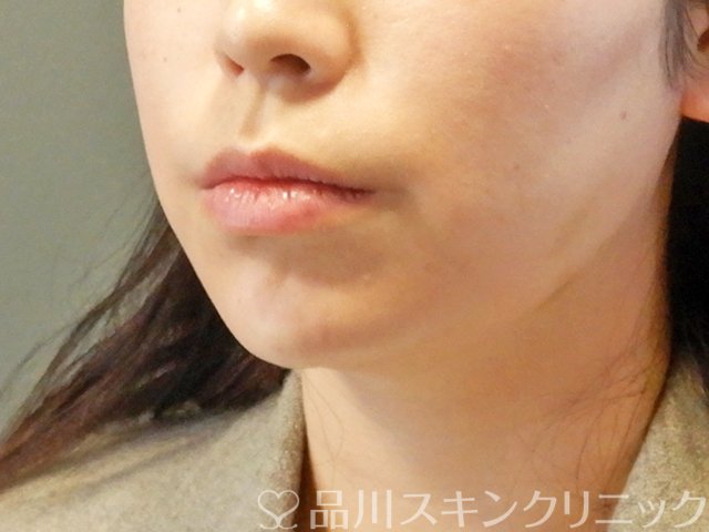 症例NO.63593のAFTER写真