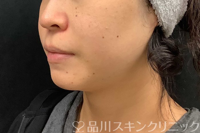 症例NO.69519のBEFORE写真