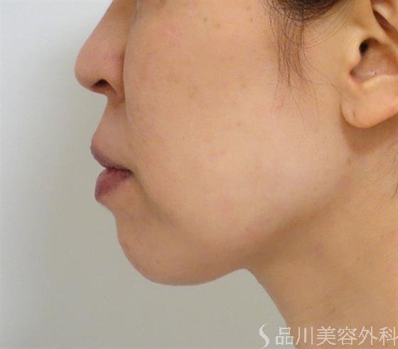 症例NO.42297のBEFORE写真