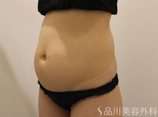 症例NO.71617のBEFORE写真