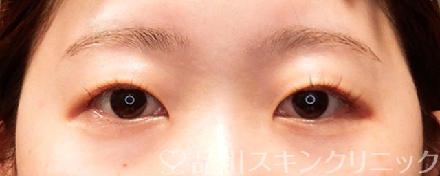 症例NO.69366のBEFORE写真