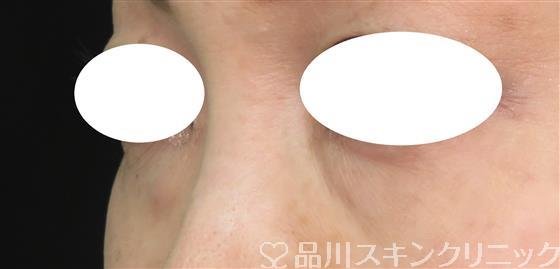 症例NO.55981のBEFORE写真