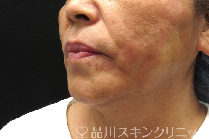 症例NO.75005のAFTER写真