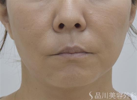症例NO.53035のAFTER写真