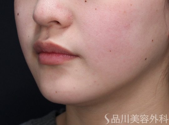 症例NO.73871のBEFORE写真