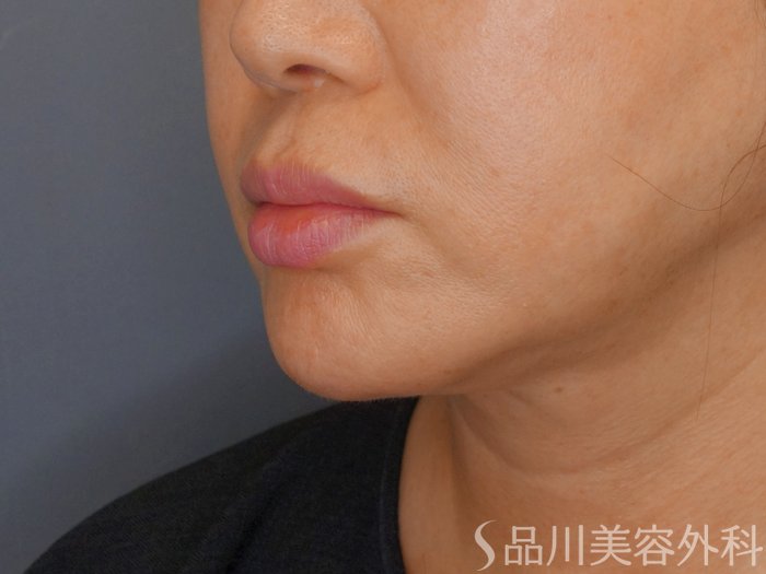 症例NO.70948のBEFORE写真