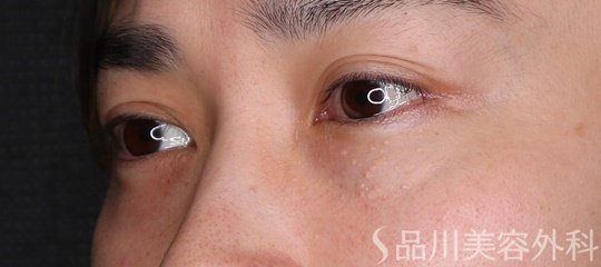 症例NO.74492のBEFORE写真