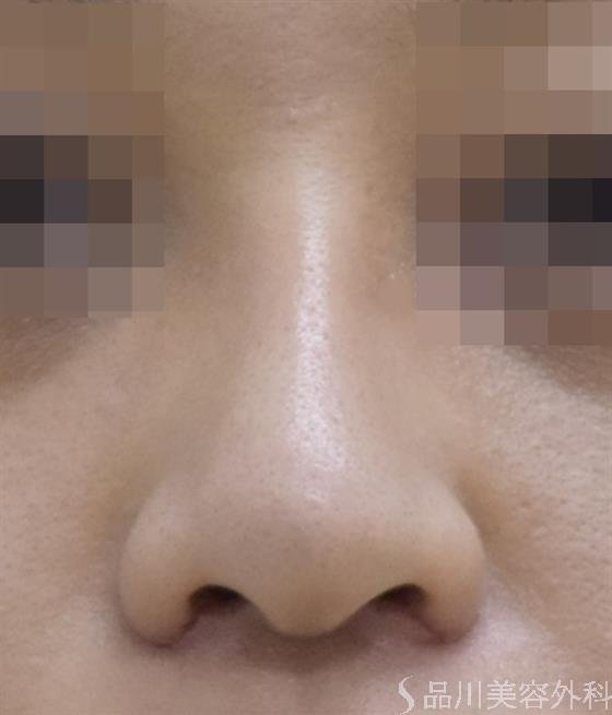 症例NO.50389のAFTER写真