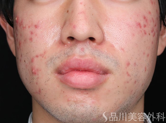 症例NO.72205のBEFORE写真