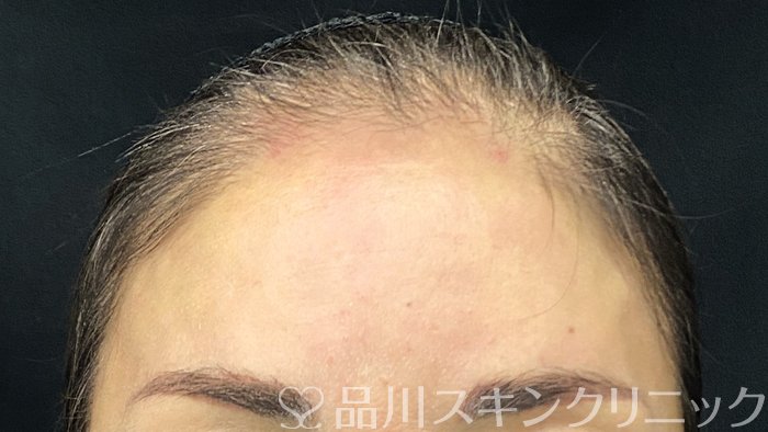 症例NO.75222のAFTER写真