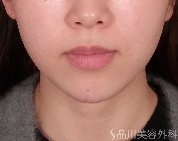 症例NO.69328のAFTER写真
