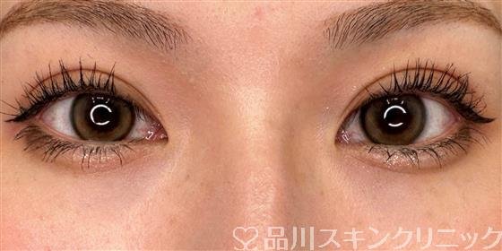 症例NO.60909のAFTER写真