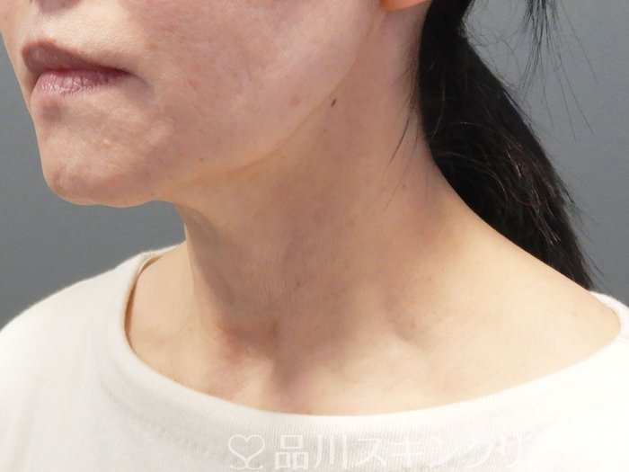 症例NO.74942のBEFORE写真
