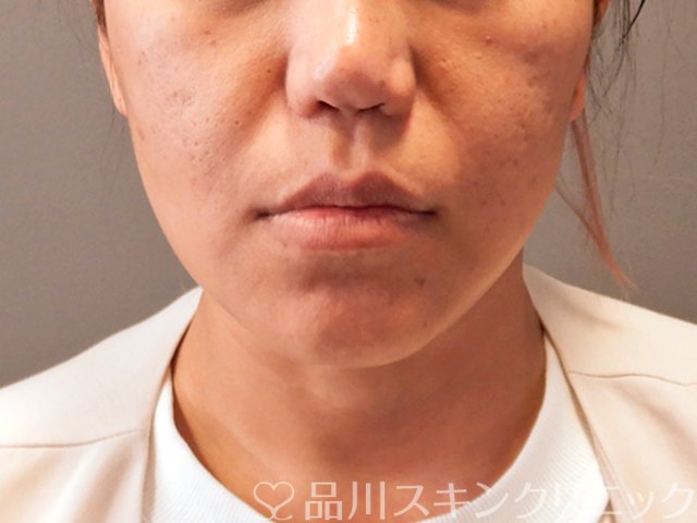 症例NO.70984のAFTER写真