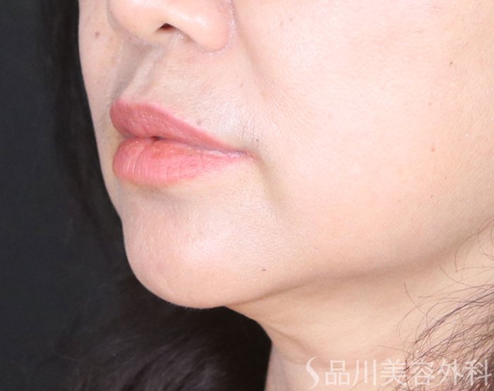 症例NO.72798のBEFORE写真