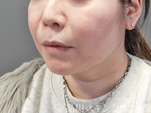 症例NO.69232のAFTER写真