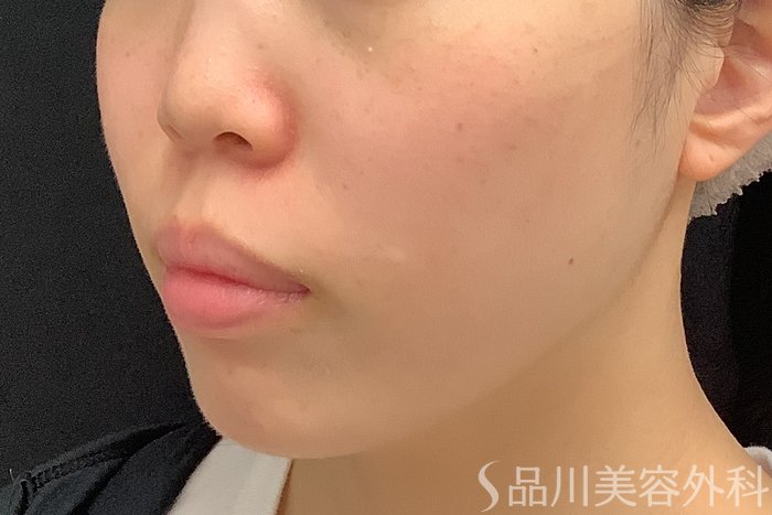 症例NO.71585のBEFORE写真