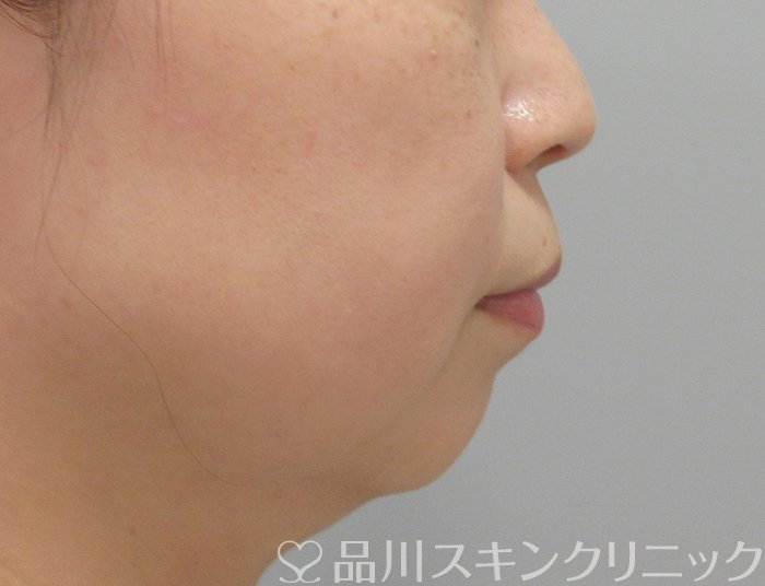 症例NO.70413のBEFORE写真
