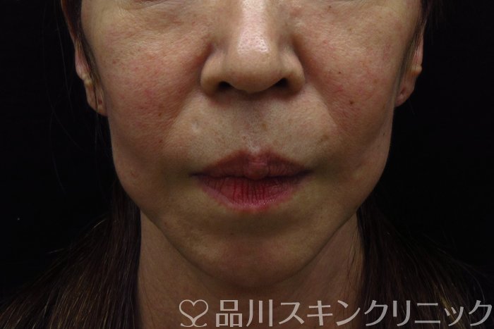 症例NO.74318のBEFORE写真
