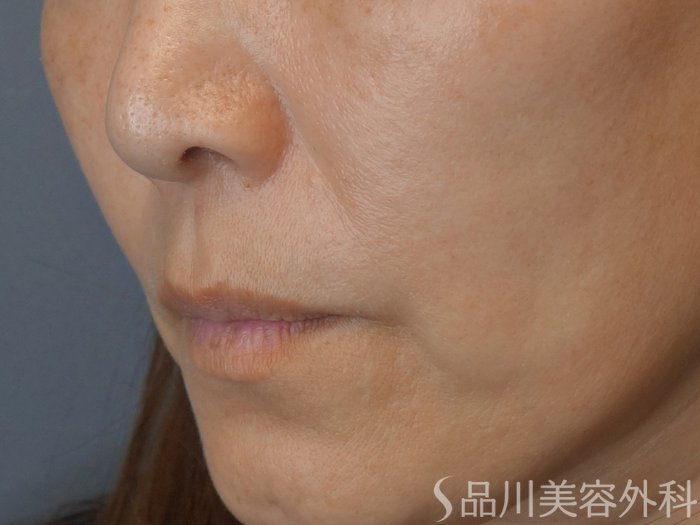 症例NO.72488のBEFORE写真