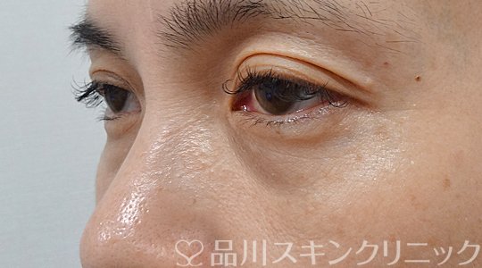 症例NO.63393のAFTER写真