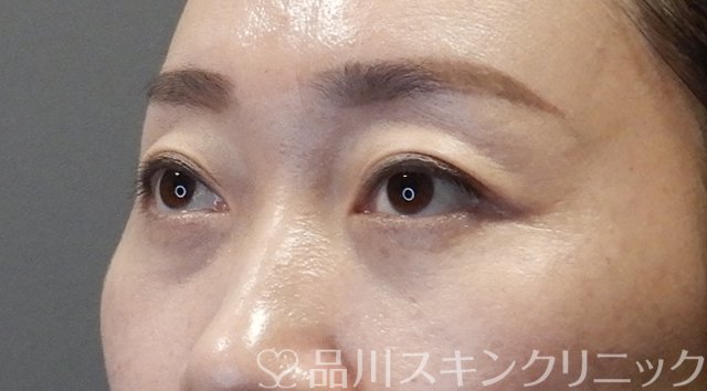 症例NO.65295のAFTER写真