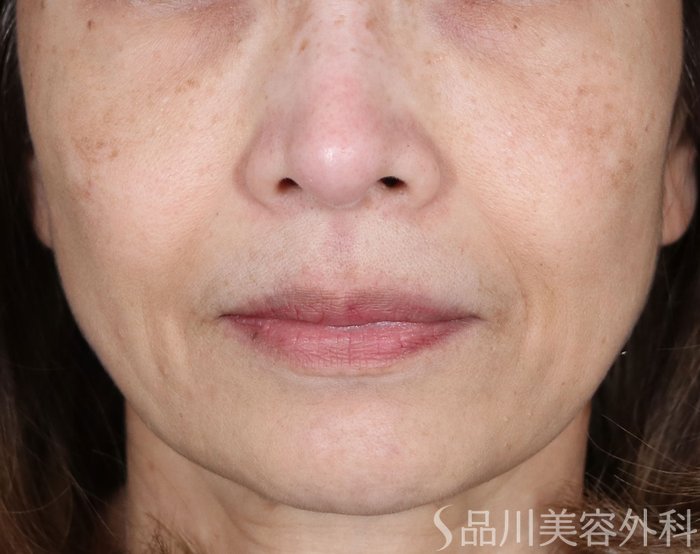 症例NO.71364のBEFORE写真
