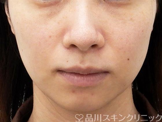 症例NO.52970のBEFORE写真