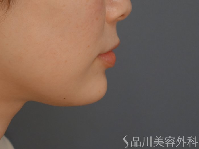 症例NO.72480のAFTER写真