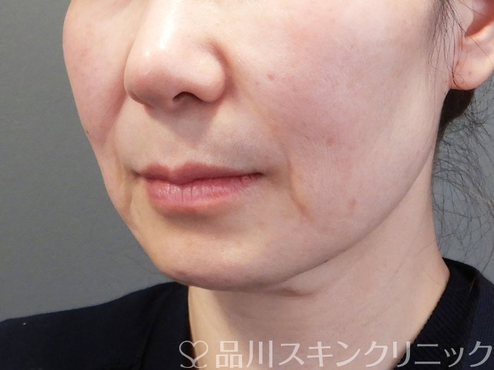 症例NO.74103のBEFORE写真