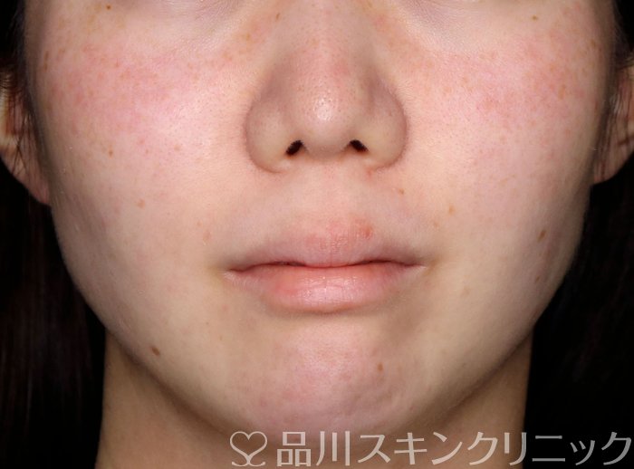 症例NO.74646のAFTER写真