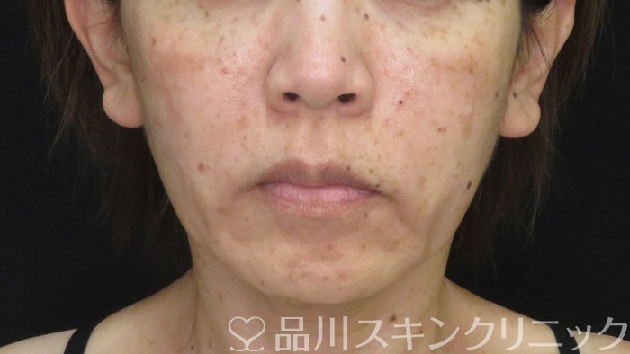 症例NO.72148のBEFORE写真