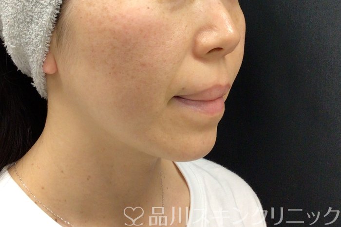 症例NO.71279のBEFORE写真