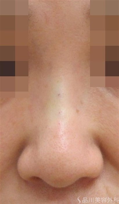 症例NO.44025のAFTER写真